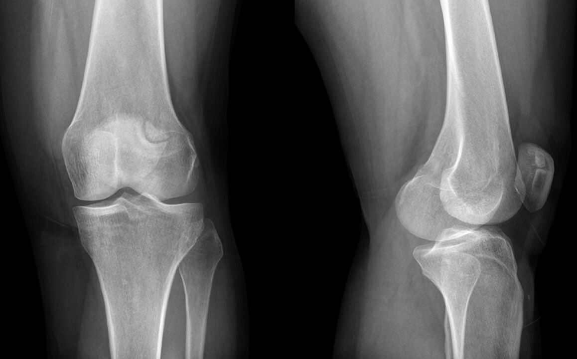 La artrosis de la rodilla en la raya x antes del uso de la hondroine