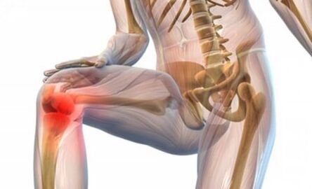 Artrosis de la articulación de la rodilla