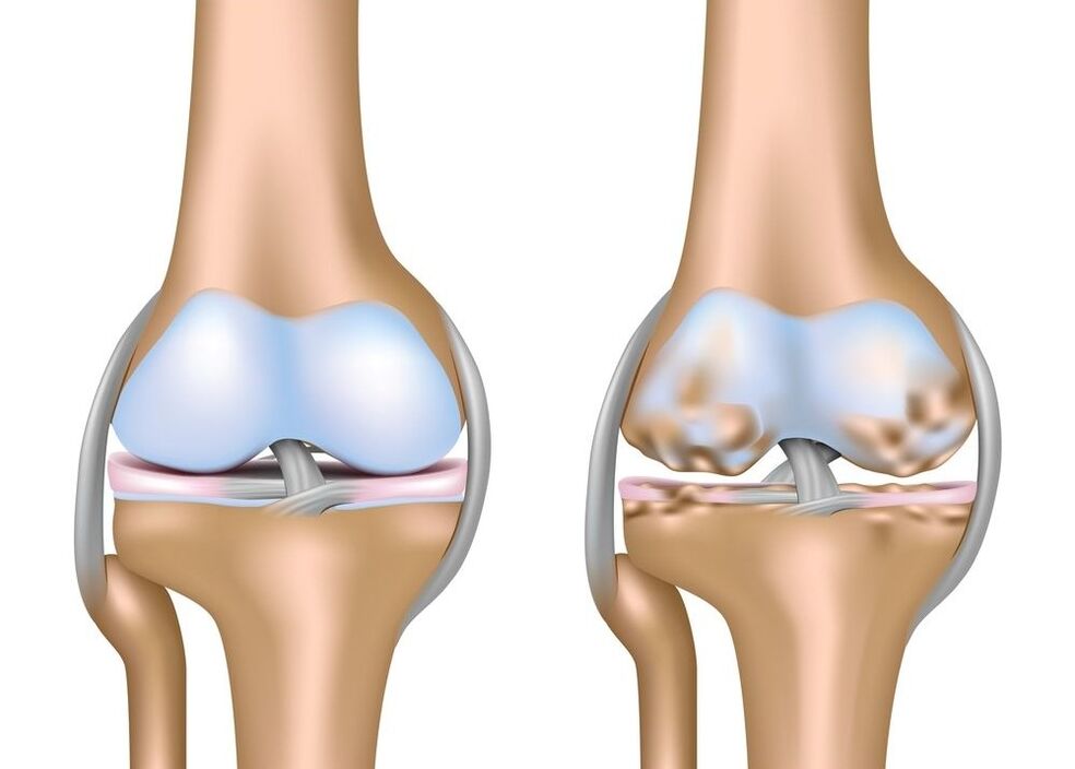 Artrosis de la articulación de la rodilla