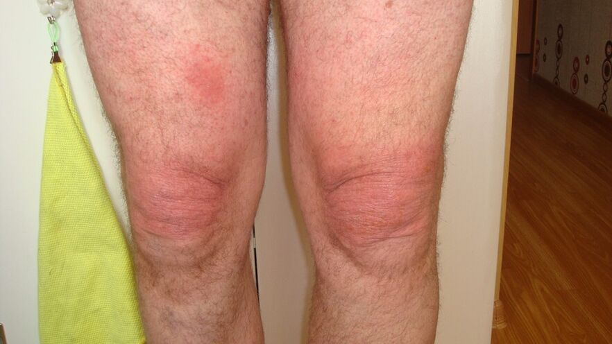 artrosis de las articulaciones de la rodilla.