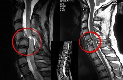 Compresión de la médula espinal indicación de cirugía